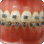 矯正歯科治療の種類と内容